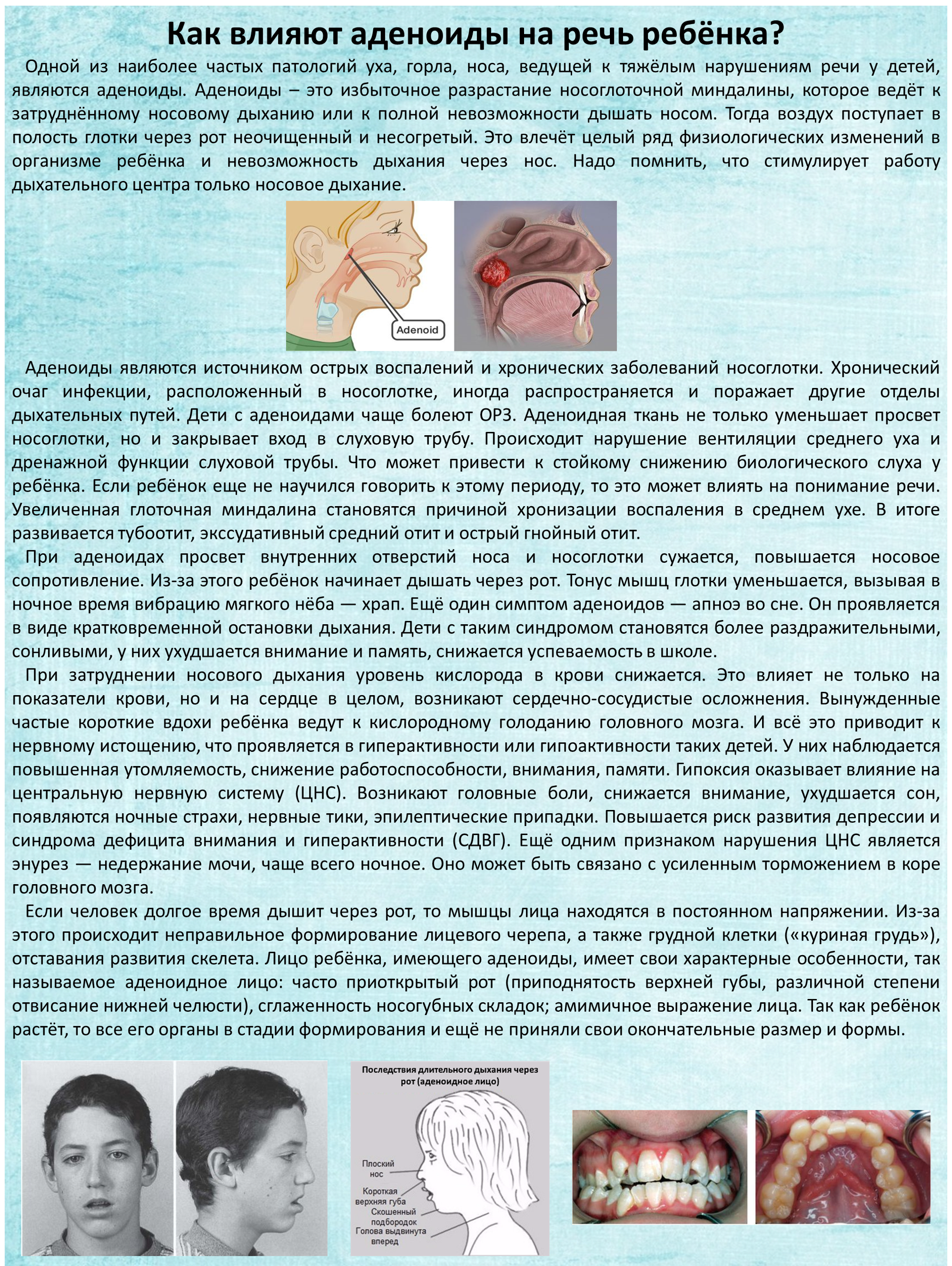 аденоиды1.png